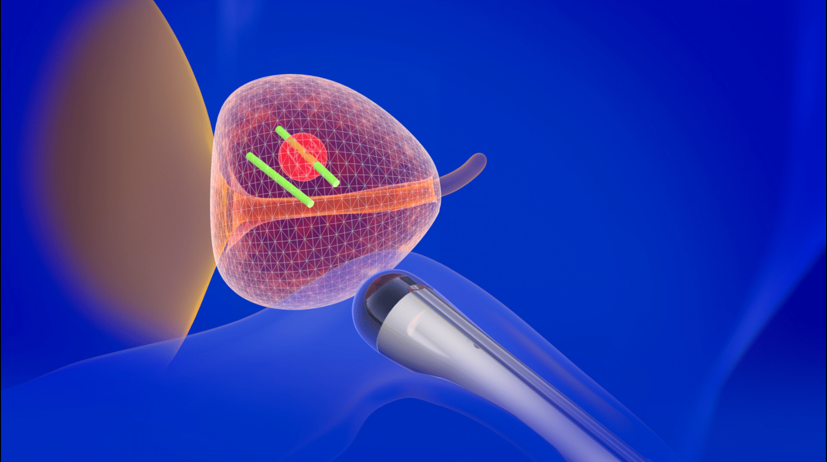 What is a fusion biopsy of the prostate